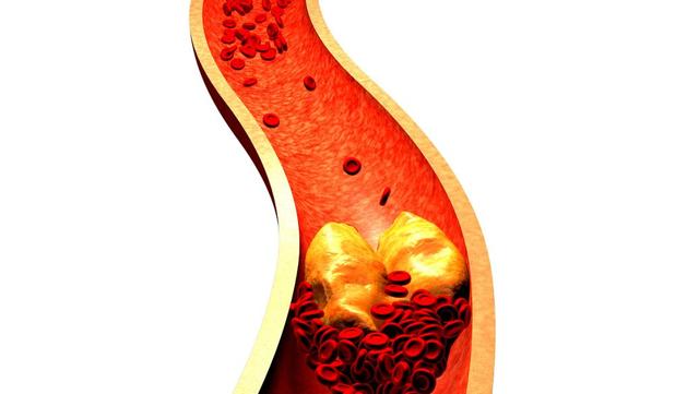 医生：高血脂患者几种食物要经常吃，能辅助控制血脂！来了解