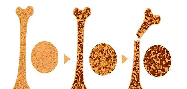 学医后才明白，增强骨密度最好的运动，不是散步游泳，而是这个