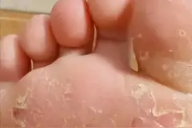 脚气为什么一直反反复复？几个简单小妙招，彻底治愈不复发！图片