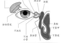 一吹风就流泪，可能是泪道堵塞？图片