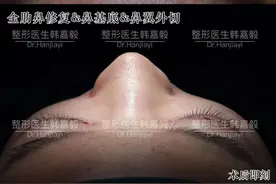 全肋鼻修复&鼻翼外切 | 驼峰鼻矫正图片