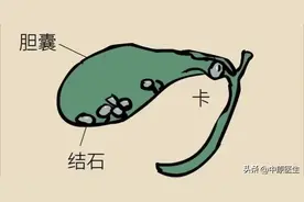 保胆取石术可去掉结石又保住胆囊？省级医院专家：都是小医院忽悠图片