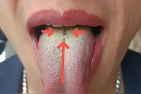 湿热不除，越补越“毒”，有一中成药疏肝健脾，除湿热，清肝火！图片