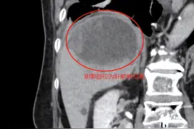 老人头晕胸闷误以为心脏病发作，竟是肝脏长了个大脓包图片