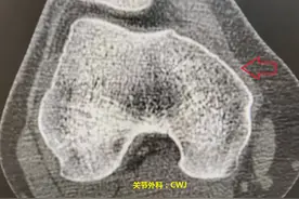 磕了、碰了，CT检查还好，但膝盖为什么老是痛？图片