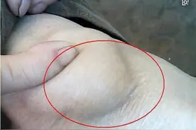 滑膜炎积液，膝盖疼痛？那2味药的外敷方，温经化瘀，缓急止痛图片