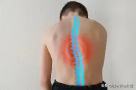 脊柱侧弯超过30°，怎么才能恢复的快？医生用一篇案例告诉您图片