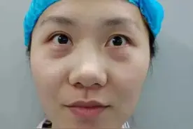 28岁去北京做了眼袋手术，术后3天~30天实拍，这3个真相不吐不快图片