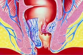 痔疮不疼不痒有肉球怎么去除好？专家教你小妙招，简单又高效图片