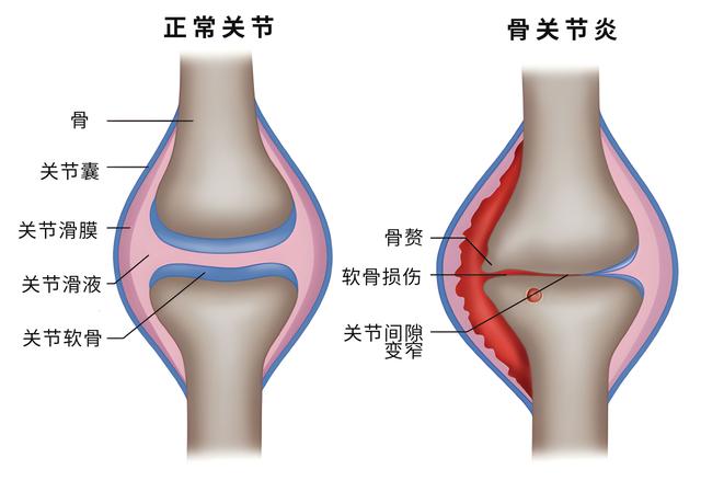 膝关节积液和哪些疾病的发生有关？医生揭晓答案