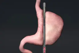 胃切除术后能“高枕无忧”？这9个问题或随时出现，需当心图片