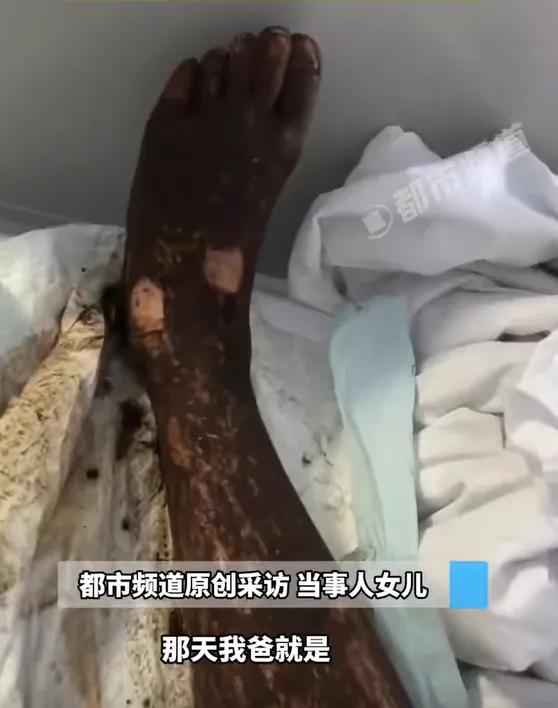 安徽一男子走路玩手机，一脚踩中互相打斗的竹叶青和五步蛇！脚被竹叶青咬两口，五步蛇咬一口