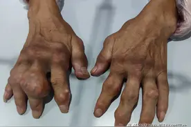 什么样的痛风患者容易长痛风石？该如何预防？图片