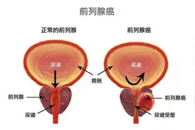 前列腺癌有哪些治疗方法？几常见疗法的优缺点，赶紧对照看看图片