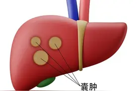 只有三味药，一升一排一散，8年的肝囊肿，消失了！图片