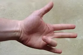 手指弯曲后伸不直怎么办？图片