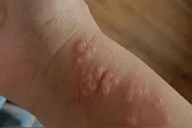 手臂神经痛，皮肤一碰就痛，担心带状疱疹！图片