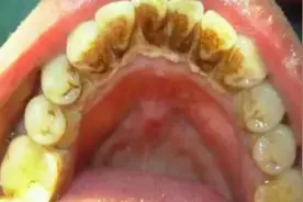 又黄又厚的牙结石不用洗牙！掌握3个省钱妙招，在家唰唰自动掉！图片