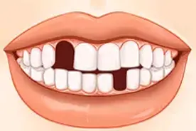 牙齿缺失，不进行修复会有什么危害？图片