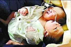 2011年，四川孕妇生下中国首例“双头宝宝”，最后怎么样了？图片