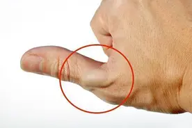 拇指性腱鞘炎建议试着处理“鼻烟窝”3分钟，或可改善图片