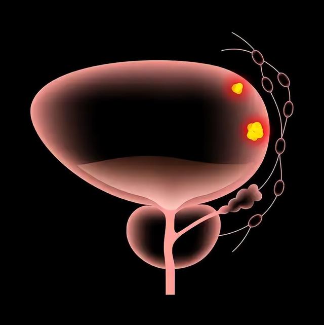 用力也尿不出来，长期插导尿管，对肾脏会有哪些改变？