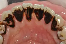 牙齿上全是又黑又黄的牙渍！掌握这几招，立马拥有健康大白牙！图片