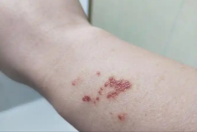 女人若是感染了“艾滋病”，胳膊上或有4种症状，都以为是皮肤病