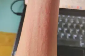 调理过敏体质脱敏，教您一招改善图片