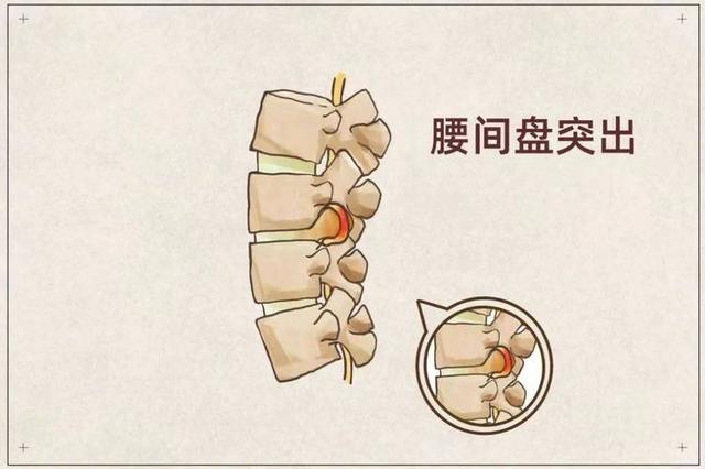 导致腰部疼痛的原因有哪些？可能和5种病情有关！记得对症下药