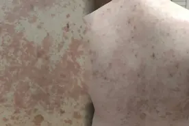 牛皮癣是不死癌症？1块钱的中药泡水，帮助把皮损“吊打”消灭图片