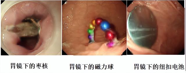 真吞金兽！11岁男童如厕拉出10克重金豆，妈妈吐槽：每天提醒他不能在外面拉