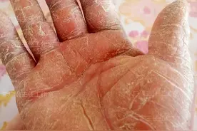 说了800遍了，慢性湿疹是脏腑出了问题，不能只当皮肤病看！！图片