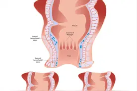痔疮为何反复发作？日常预防要做好，远离尴尬不是梦图片