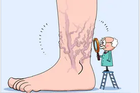 【漫绘科普】腿上为什么会长“蚯蚓”？图片