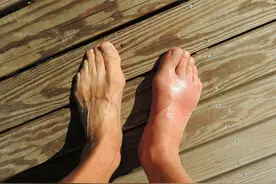 痛风到底不能吃什么？图片