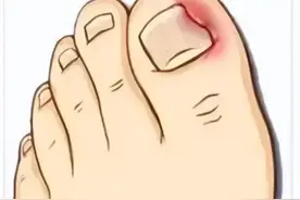 甲沟炎，问题不算大，但伤害性极强！遇到这个疾病该咋办？图片