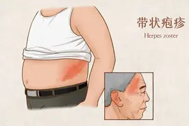 95%的人潜在患有带状疱疹，3类人高发，专家提醒：补充这类维生素图片