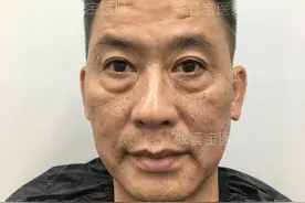 50岁大哥咬牙做了眼袋手术，20天从老头变“靓仔”，公开真实感受图片