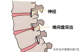 腰椎盘突出压迫神经怎么办？图片