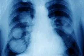 肺结节，是良性还是恶性?肺CT报告上写的很清楚，这3点不能大意图片