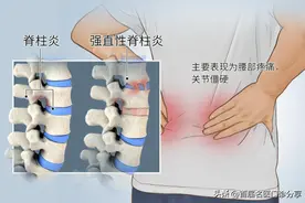 强直性脊柱炎是筋骨弱，督脉闭，刘教授这样治，痛全消，活动良好图片