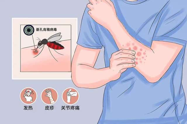基孔肯雅热暴发 到底有多难受