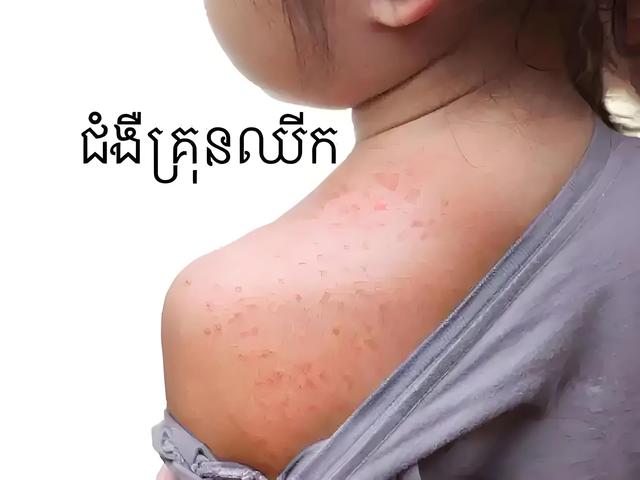 什么是基孔肯雅热，该怎样防护？
