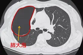 检查发现肺大疱要紧吗？什么是肺大疱，有什么危害，要怎样处理？图片