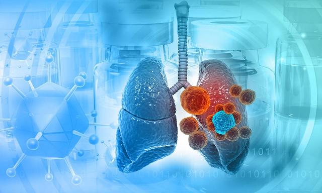 医生提醒：肺结节随访复查的5个黄金时间点	，错过可能误大事