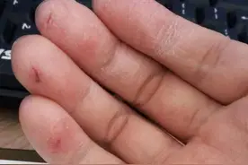 双手反复爆皮干裂？掌握几个在家操作法，顽固裂口一抹就好！图片