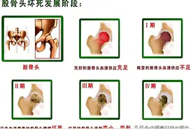 股骨头坏死早期能治好吗？图片