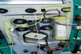 23岁女孩抽出“牛奶血”，医大四院通过置换图片