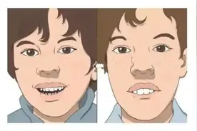 嘴巴增厚、外突，孩子越来越丑，腺样体面容到底该怎么治？图片